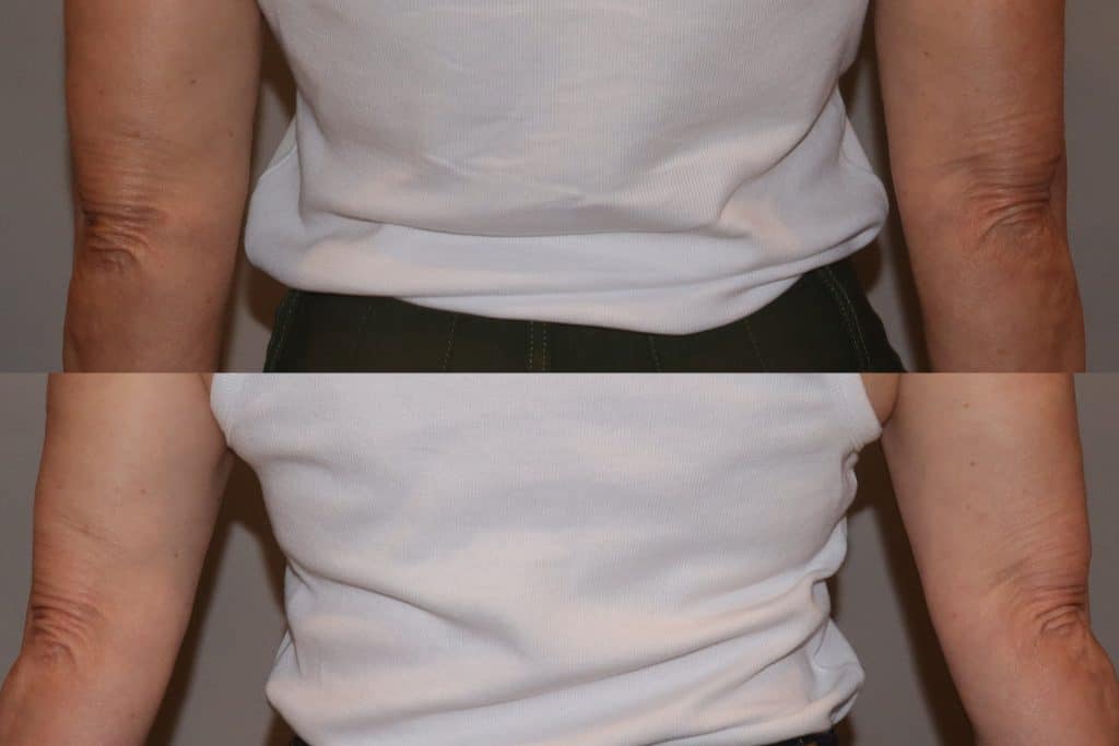 before and after photo from sofwave treatment for arms