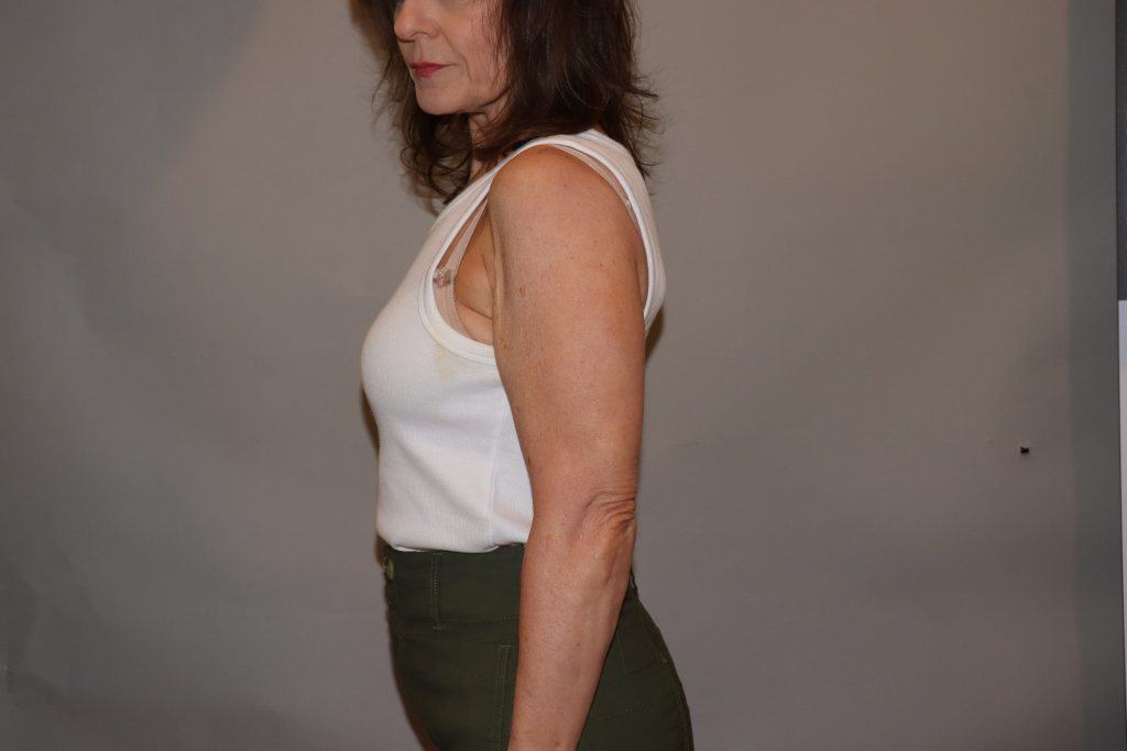 brunette woman wearing a white tank top and green pants in a side pose to show her upper arms before Sofwave treatment